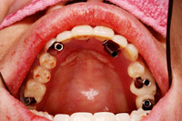 即日インプラント手術：仮歯を即時重合レジンで固定